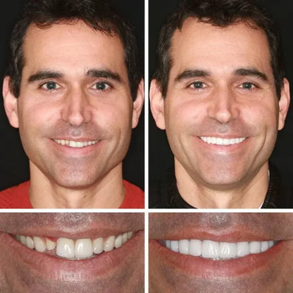🌎Ends Today: 60% OFF! ⏰ Medical Full Denture with Strong Suctiond🦷Obtain American Dental Association (ADA) Certification