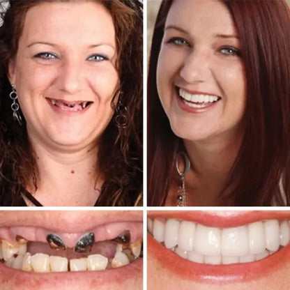 🌎Ends Today: 60% OFF! ⏰ Medical Full Denture with Strong Suctiond🦷Obtain American Dental Association (ADA) Certification